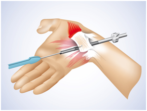 Operationsverfahren endoskopisch Karpaltunneloperation