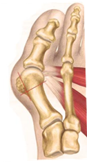 Spreizfuß mit Hallux valgus