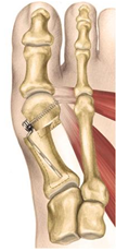 Hallux valgus Operation nach Stoffella